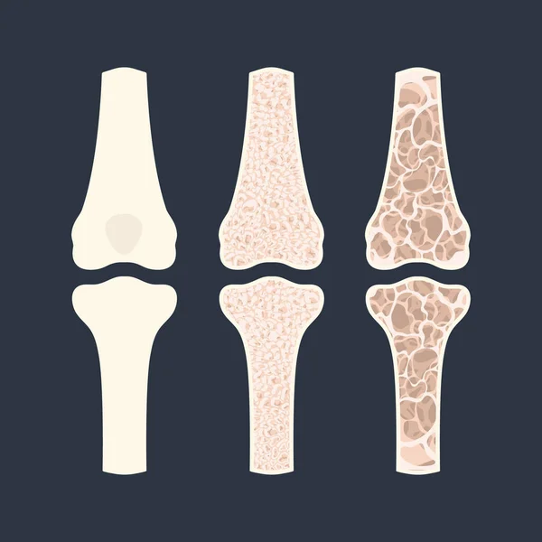 Osteoporosis enfermedad de pérdida de densidad ósea infografías médicas — Vector de stock