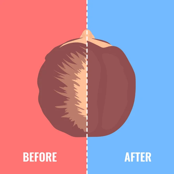 Mujer calva antes y después del trasplante de cabello — Vector de stock