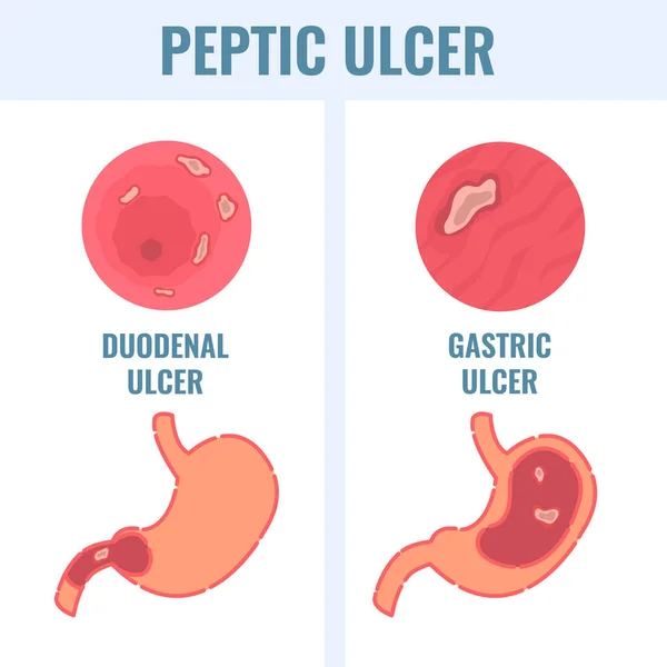 Peptic Ulcer Stomach Disease Infographic Poster Endoscopic Image Stomach Duodenal — Stock Vector