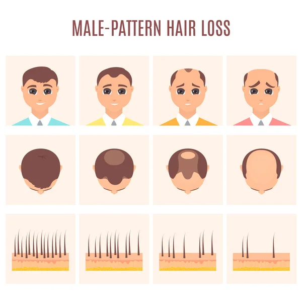 Homem antes e depois do tratamento da perda de cabelo na vista frontal e superior —  Vetores de Stock