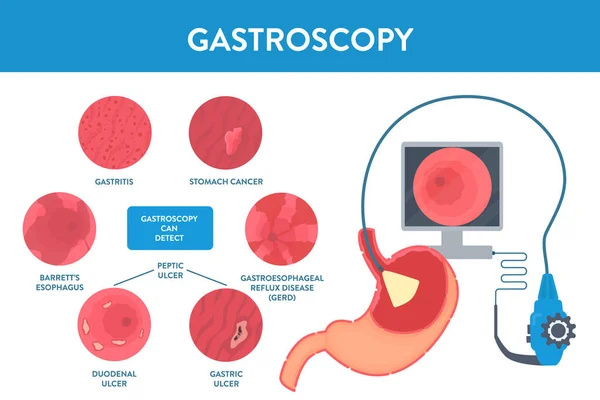 Gastroscopy procedure of stomach examination with endoscope — Stock Vector