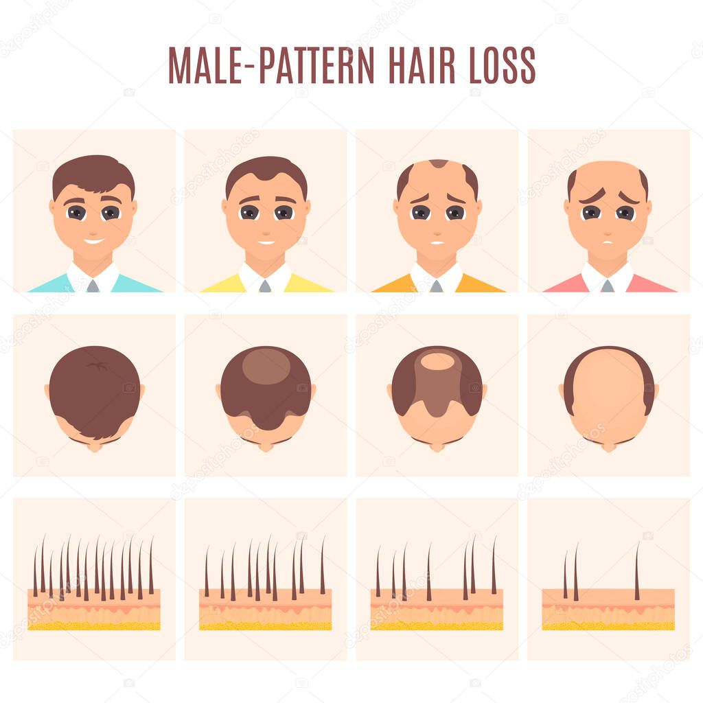 Man before and after hair loss treatment in front and top view