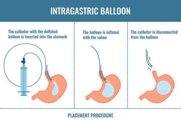 Fases del procedimiento de pérdida de peso con balón gástrico mostradas en el estómago — Vector de stock