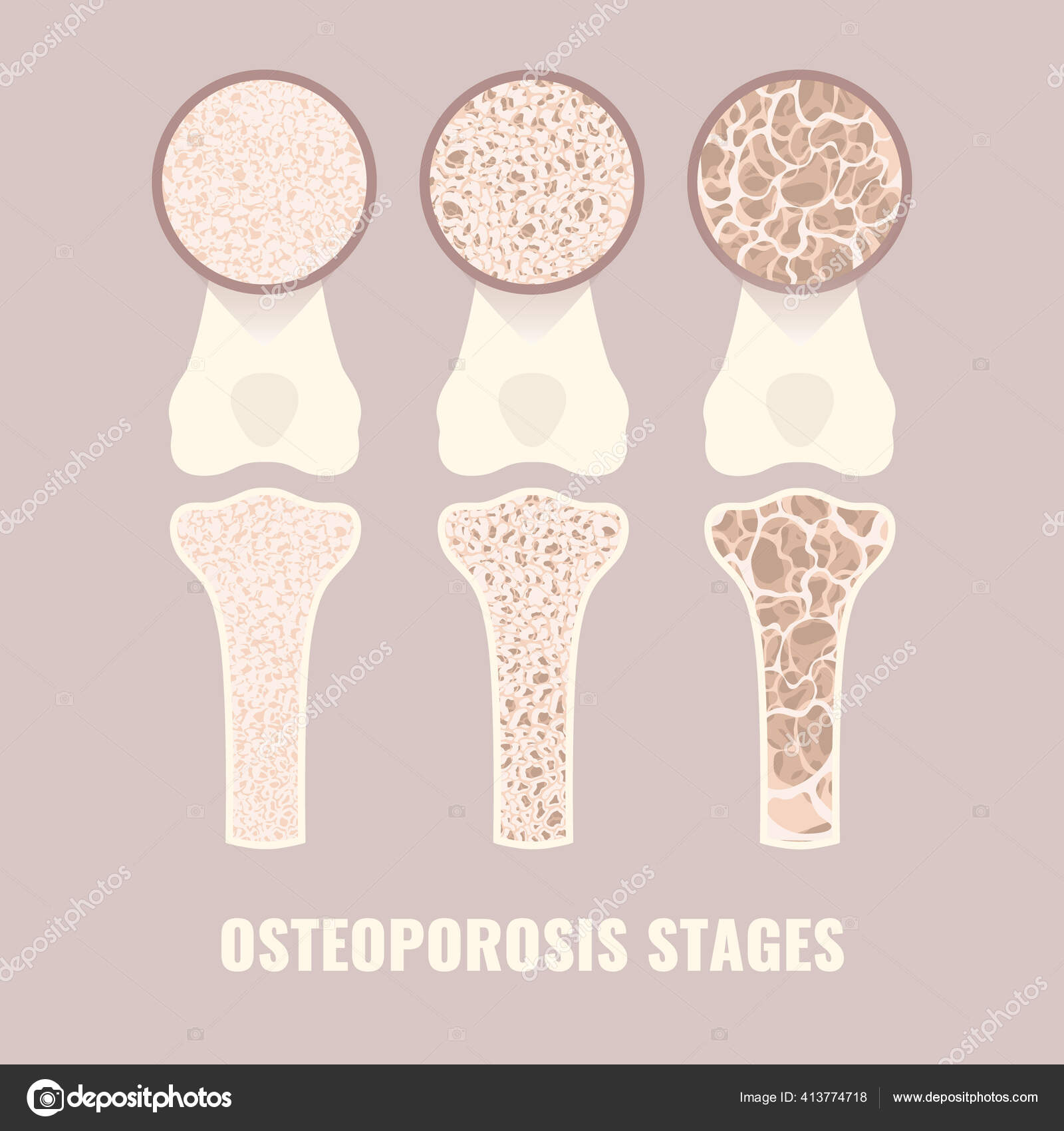 Osteoporosis bone density loss disease medical infographics Stock Vector  Image by ©Naumas #413774718