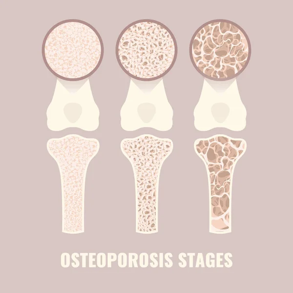 Osteoporoza choroba utraty gęstości kości infografika medyczna — Wektor stockowy