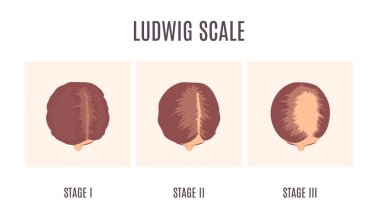 Kadın bilgilerinde kellik ölçeği Ludwig ölçeğinde