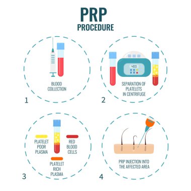 Trombosit zengini plazma prosedürü aşamaları. PRP saç dökülme tedavi aşamaları. Alopecia 'nın organ nakli klinikleri ve teşhis merkezleri için tıbbi tasarım şablonu. Vektör illüstrasyonu