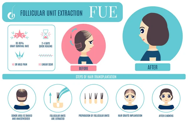 Infográfico de tratamento FUE para mulheres —  Vetores de Stock