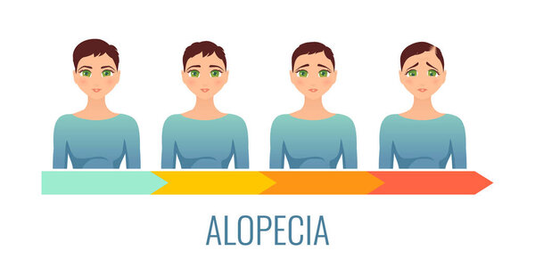Female alopecia stages set.