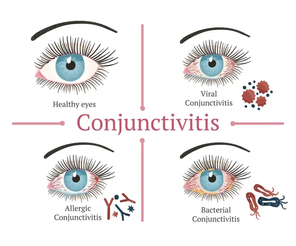 Enfermedad ocular. Oftalmología ilustración sanitaria . — Vector de stock