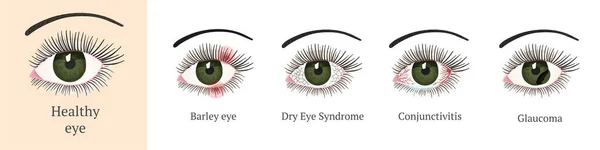 Problemas oculares más comunes — Vector de stock