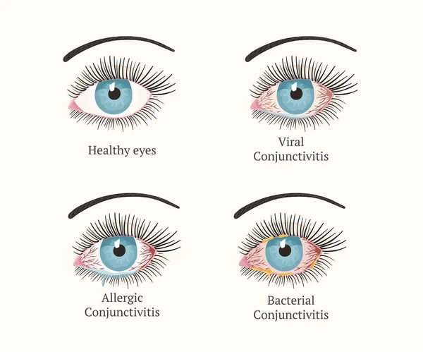 Enfermedad ocular. Oftalmología ilustración sanitaria . — Vector de stock