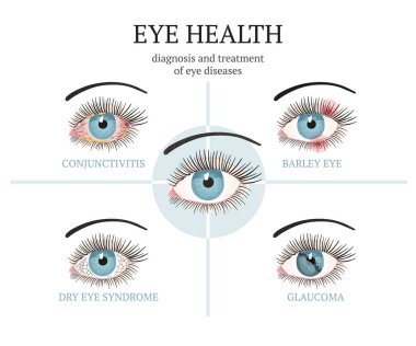 Most common eye problems - conjunctivitis, glaucoma, dry eye syndrome, barley eyes. clipart
