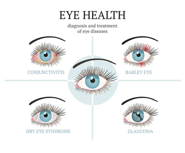 Problemas oculares mais frequentes - conjuntivite, glaucoma, síndrome do olho seco, olhos de cevada . —  Vetores de Stock