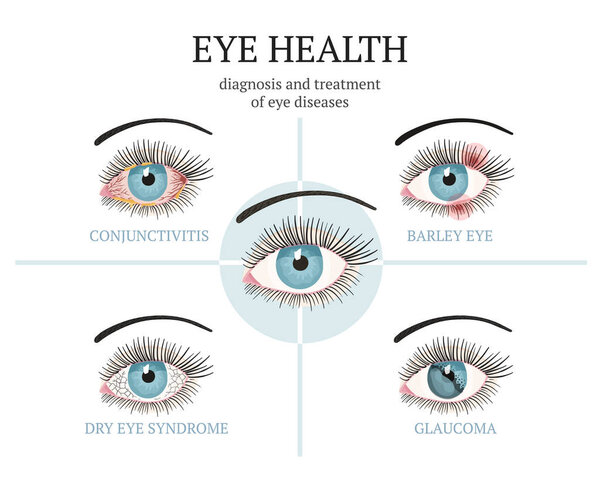 Most common eye problems - conjunctivitis, glaucoma, dry eye syndrome, barley eyes.