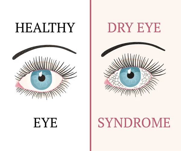 Doença ocular. Oftalmologia ilustração de saúde . —  Vetores de Stock