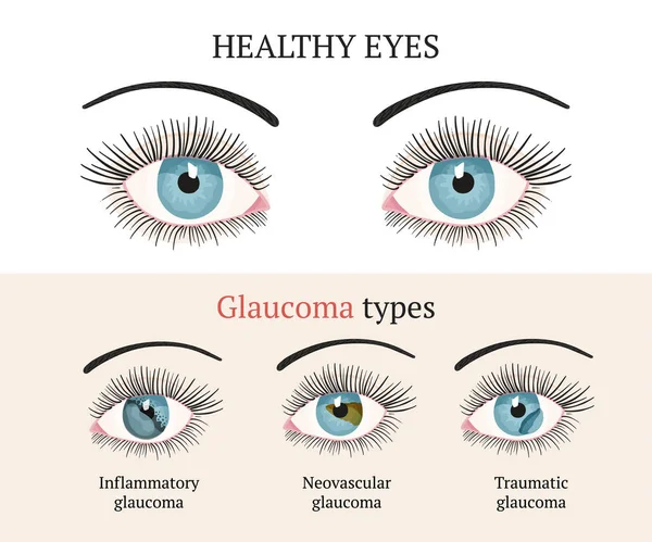 Doença ocular. Oftalmologia ilustração de saúde . —  Vetores de Stock