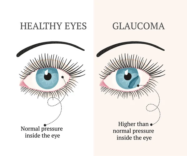 Doença ocular. Oftalmologia ilustração de saúde . —  Vetores de Stock