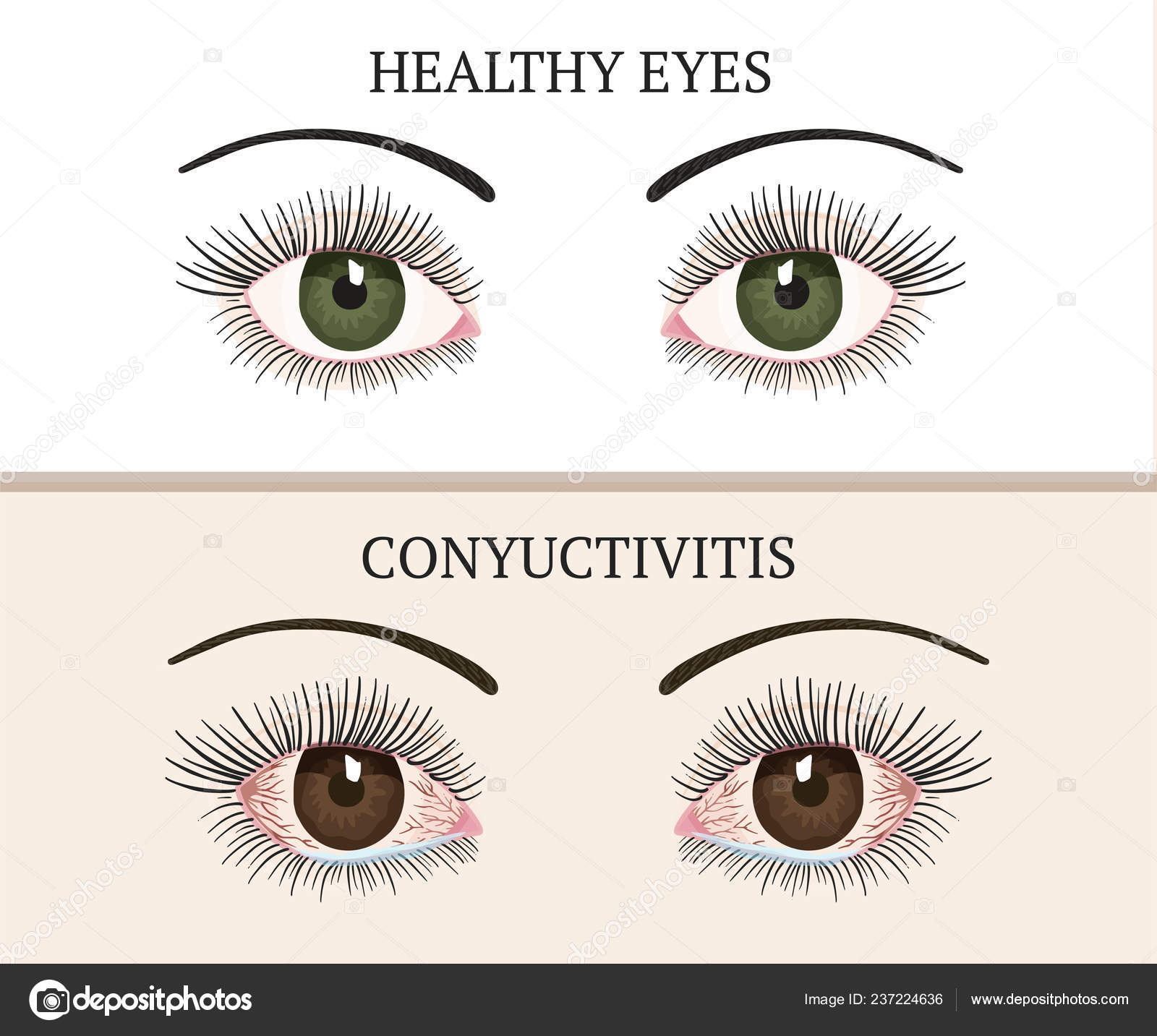 Ojos irritados imágenes de stock de arte vectorial | Depositphotos Ojos irritados imágenes de stock de arte vectorial | Depositphotos