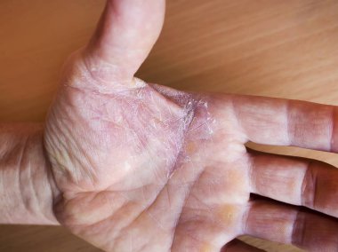 Elim peeling ve kuru cilt. Tedavi ve korunma cilt hastalıkları kavramı. Dermatoloji.