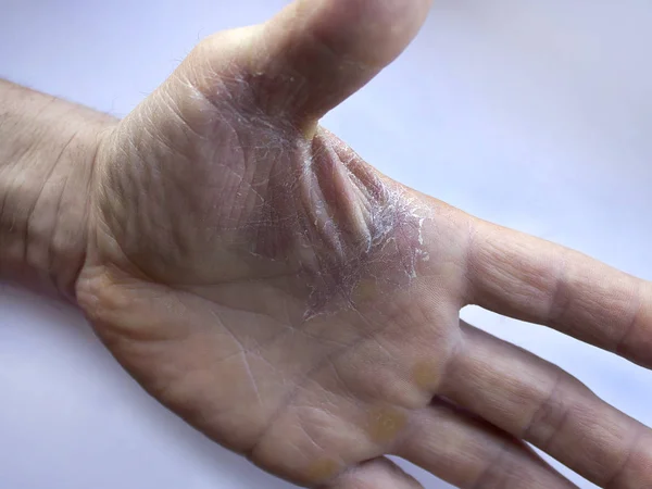 手的去皮和干燥的皮肤 治疗和预防皮肤病的概念 — 图库照片