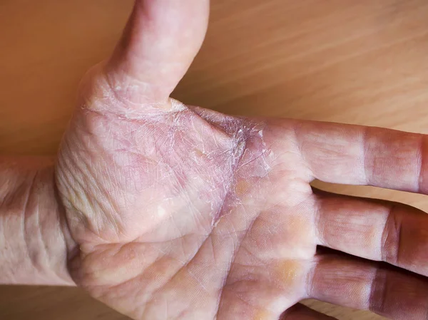 Descascamento Pele Seca Das Mãos Conceito Tratamento Prevenção Doenças Pele — Fotografia de Stock