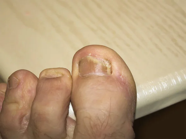 Foot foot. Disease of the skin. Fungal infection.