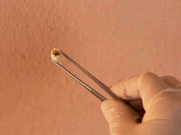 Doktor, büyük bir kusur ile bir diş cımbızla elinde. Diş Hekimliği Diş önleme ve tedavi kavramı.