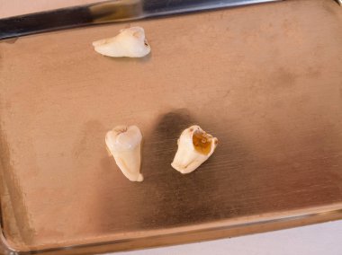 Diş metal bir tepsi içinde kaldırıldı. Diş Hekimliği Diş önleme ve tedavi kavramı.