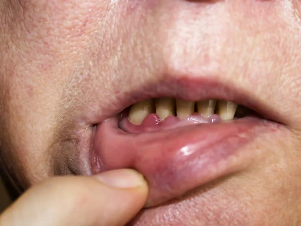 Periodontitis Inflammatory Process Gum Area Exposure Necks Teeth Doctor Examines — Stock Photo, Image