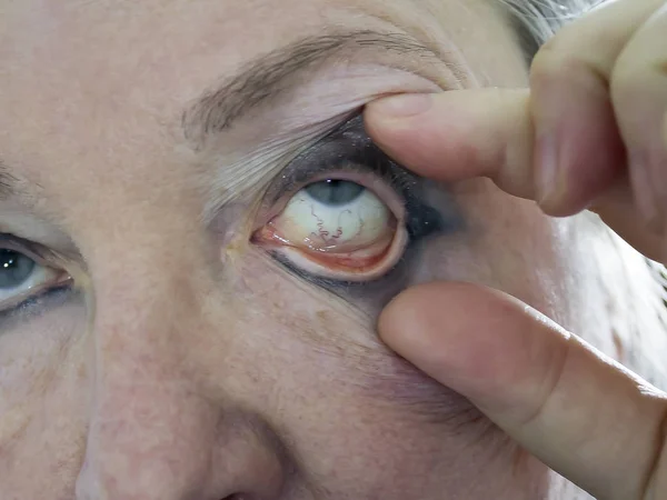 The eyes of a woman are wide open with the hand of a doctor. Swollen and reddened veins are visible on the eyeball. Ophthalmologist examination. The concept of prevention and treatment of eye disease.