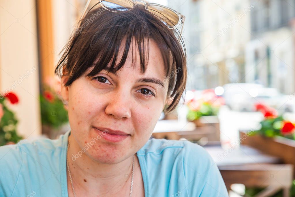 woman portrait with acne on face. skin problems