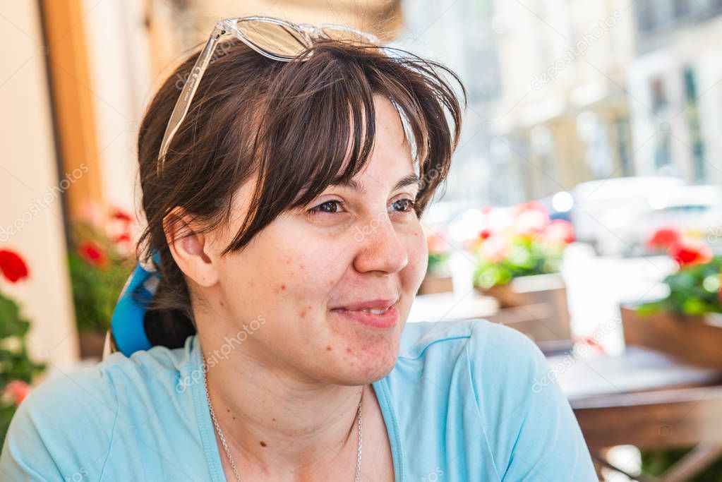 woman portrait with acne on face. skin problems