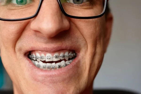 Crazy face of guy with braces on his teeth with smile and glasses. Happy expression. Portrait of man close up