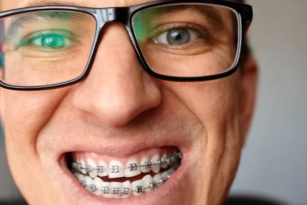 Crazy face of guy with braces on his teeth with smile and glasses. Happy expression. Portrait of man close up