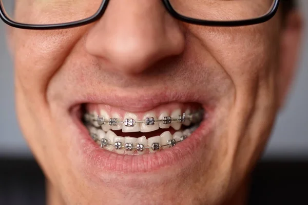 Crazy face of guy with braces on his teeth with smile and glasses. Happy expression. Portrait of man close up