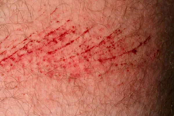 Scratch Skin Wound Cut Skin Red Blood Hairy Part Man — Stock Photo, Image