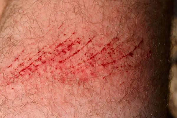 Scratch Skin Wound Cut Skin Red Blood Hairy Part Man — Stock Photo, Image