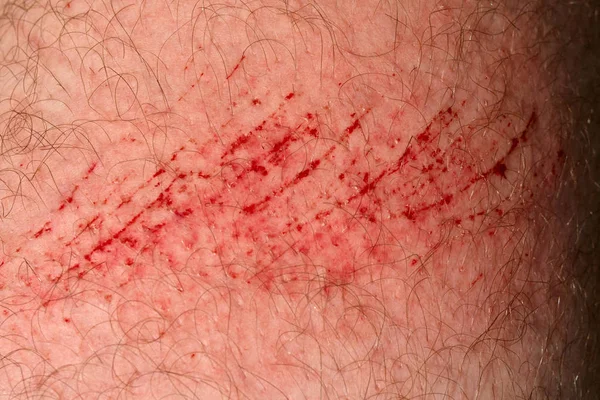 Scratch Skin Wound Cut Skin Red Blood Hairy Part Man — Stock Photo, Image