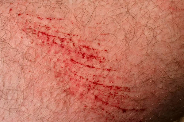 划伤皮肤 伤口或在皮肤上割伤 红色血液 男人身体特写镜头的毛茸茸的部分 — 图库照片