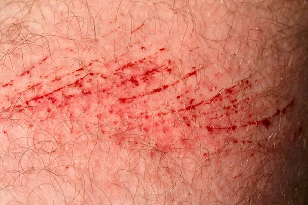 Scratch Skin Wound Cut Skin Red Blood Hairy Part Man — Stock Photo, Image