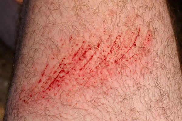 划伤皮肤 伤口或在皮肤上割伤 红色血液 男人身体特写镜头的毛茸茸的部分 — 图库照片
