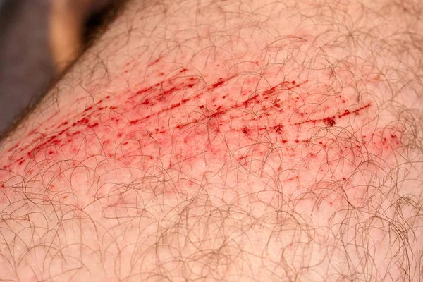 Scratch Skin Wound Cut Skin Red Blood Hairy Part Man — Stock Photo, Image