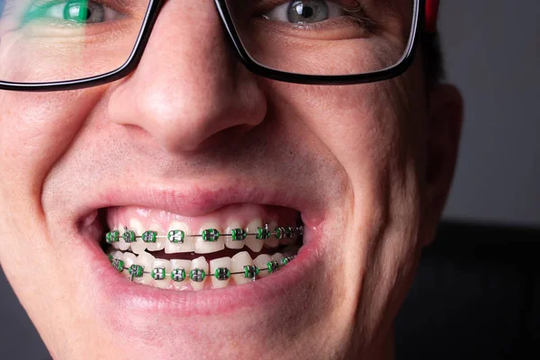 Portrait of a man with crooked teeth and metal braces with green rubber bands close-up. Young man with dental orthodontic braces.