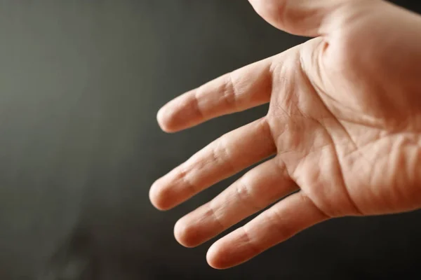 Adult Hand Raynaud Syndrome Phenomenon Закройте Руку Пальцами Темном Фоне — стоковое фото