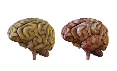Human brain comparison healthy and inflamed, damaged clipart