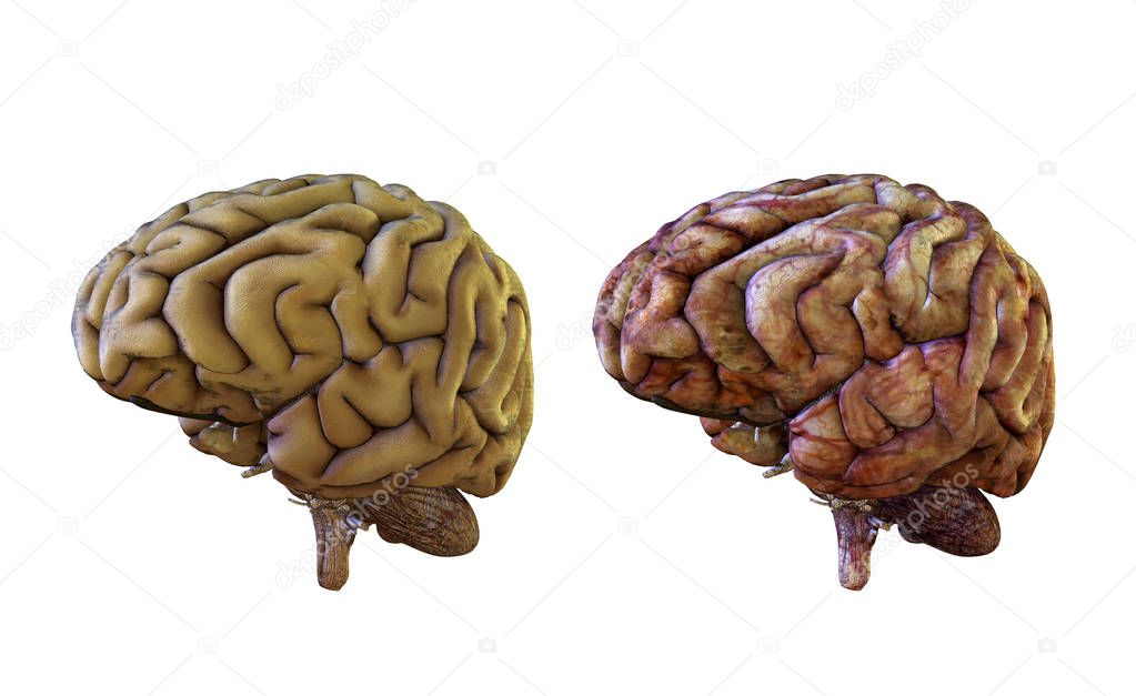 Human brain comparison healthy and inflamed, damaged