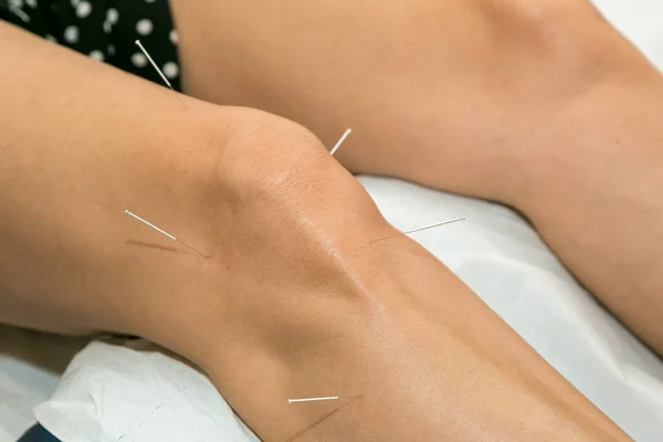 Dizinde akapunktur, dizinde iyileşme için osteoartrit tedavisi.