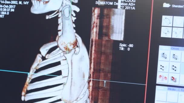 Врач, работающий с магнитно-резонансной томографией скелета пациента — стоковое видео