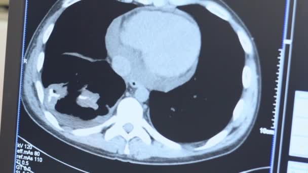 Magnetresonanzbild des menschlichen Körpers auf dem Monitor — Stockvideo